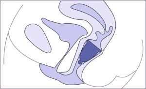 Менструална чашка | Размер S | Me Luna